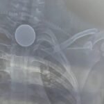 Korba : 8 वर्षीय मासूम के सीने में सिक्का फंसने से मौत का मामला, पोस्टमार्टम पर नहीं मिला सिक्का, अब...